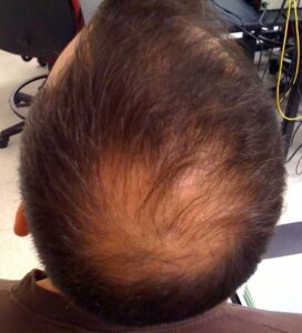 Perte de cheveux